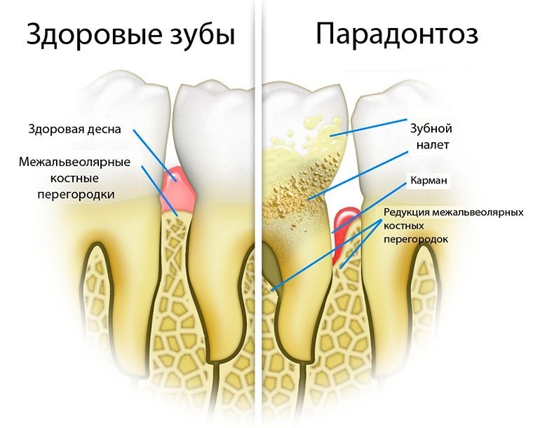 Пародонтоз| Стоматологическая клиника «Стоматология на Спасской» Киров