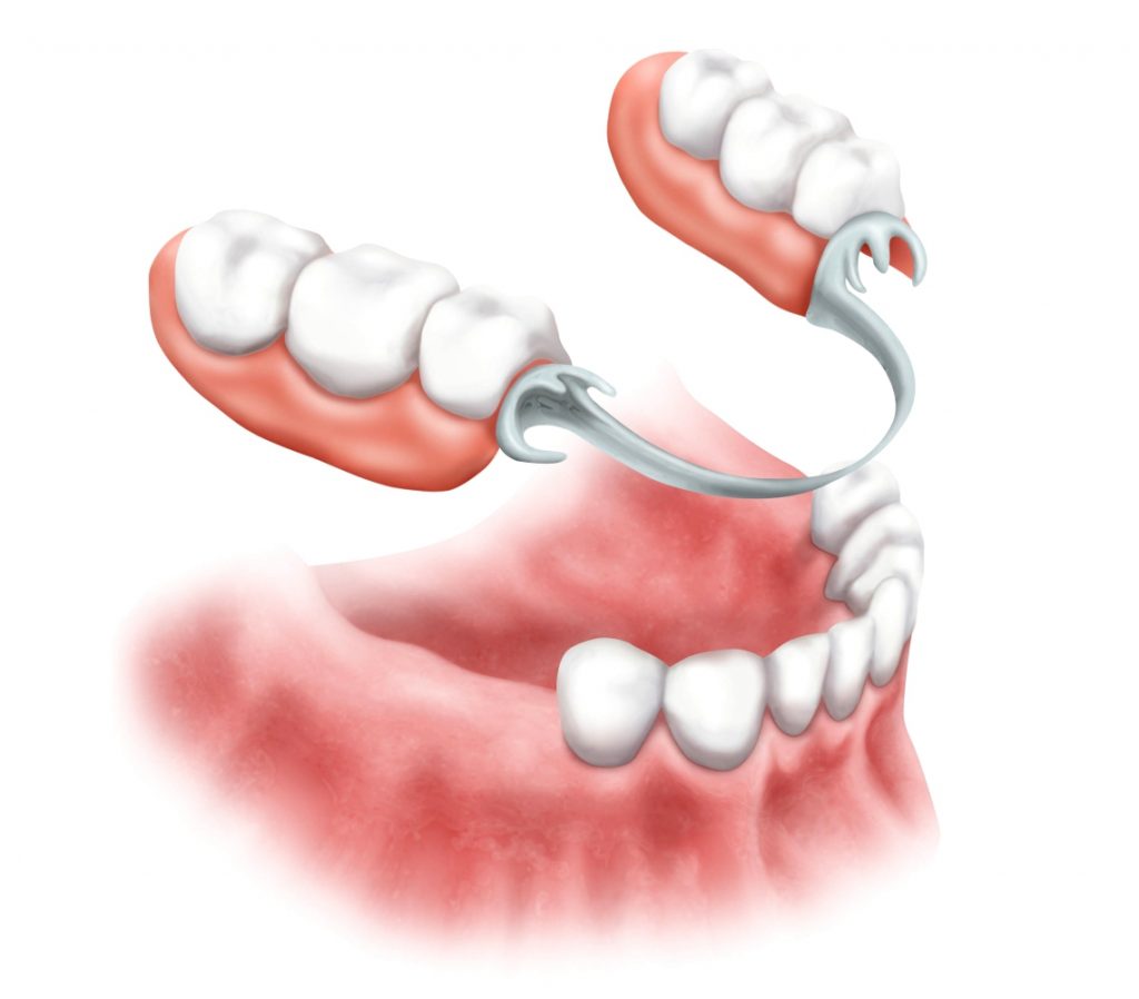 Зубное протезирование | Стоматологическая клиника «Стоматология на Спасской» Киров