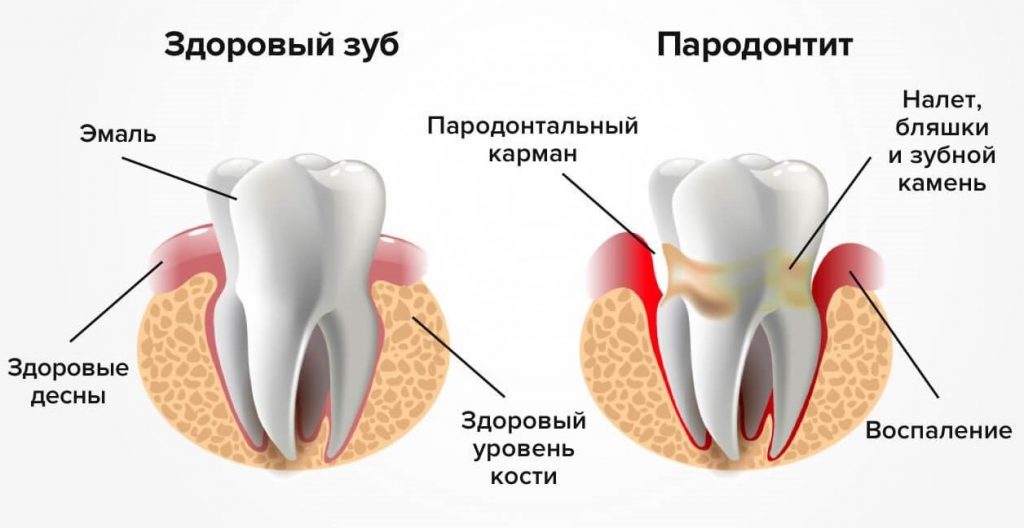 Лечение пародонтит | Стоматологическая клиника «Стоматология на Спасской» Киров